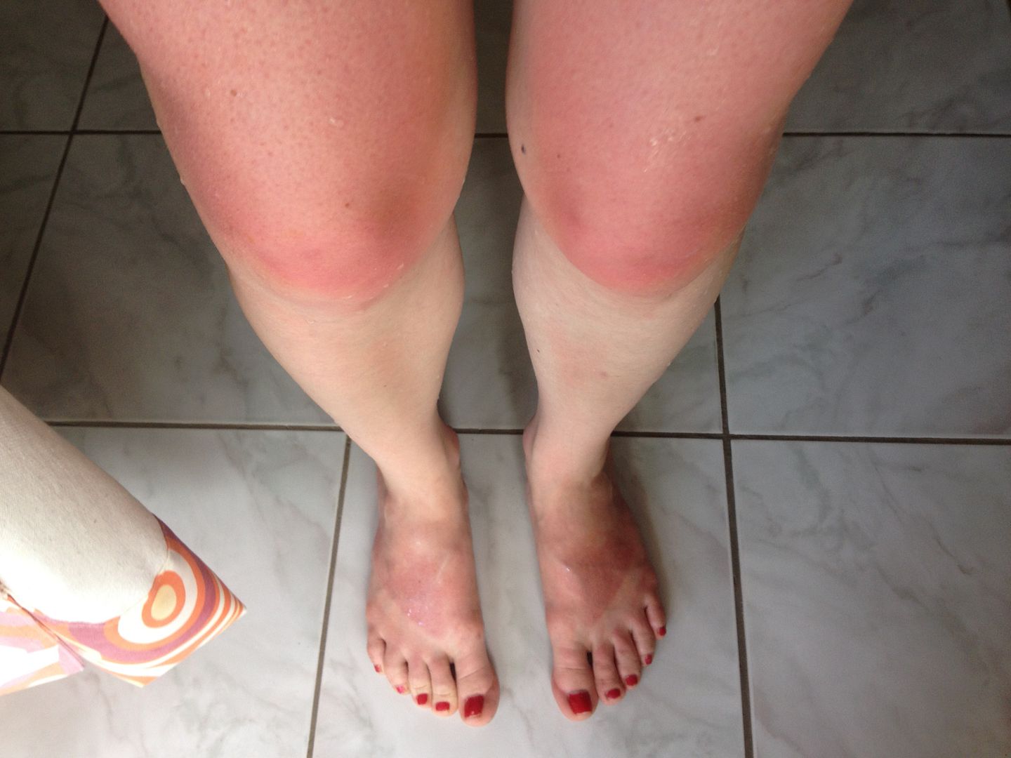 Sun (and Sunburn) in the Philippines